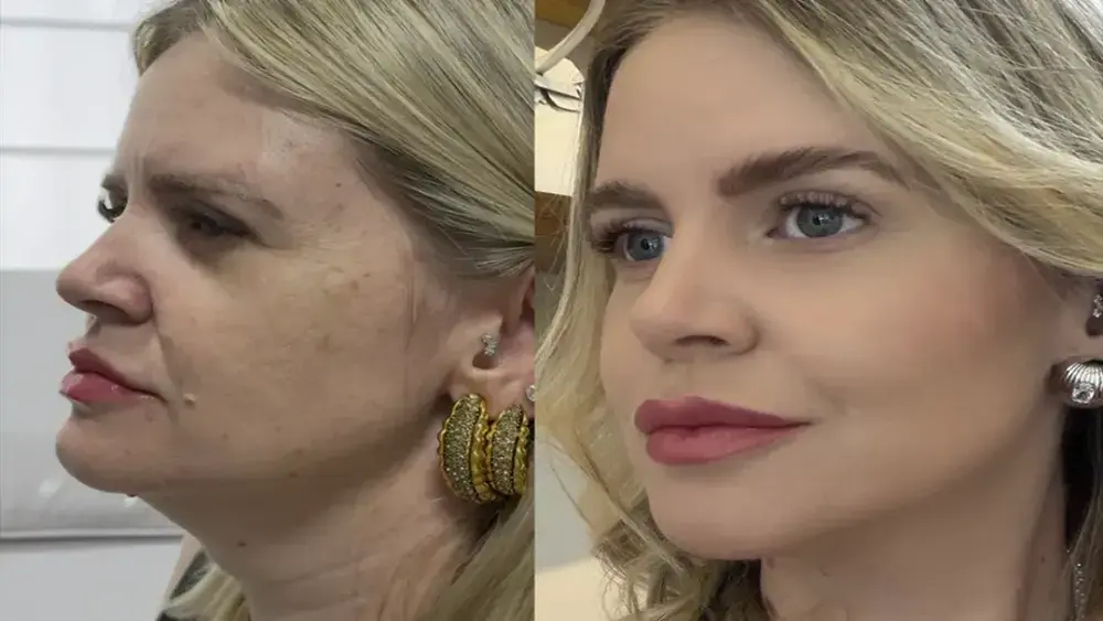 Estética regenerativa: o novo luxo do rejuvenescimento natural
